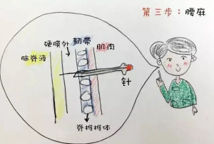 硬膜外麻醉体位图片