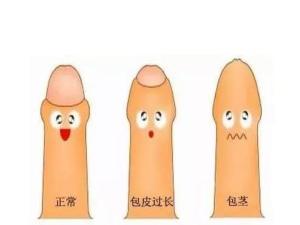 韩式包皮环切术