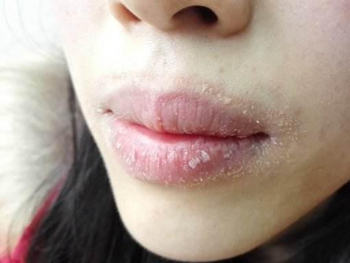 干燥脱屑性唇炎 搜狗百科