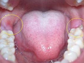 磨牙后区肿图片