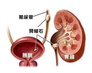 我父亲因左肾结石做了取石手术一个月后刀口附近却鼓起来了现在腹部