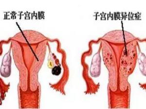 子宫内膜不规则脱落