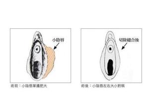 小阴唇肥大