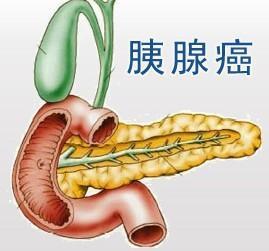 胰腺癌