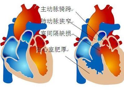 肺动脉瓣狭窄图片图片