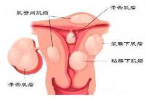 血性白带 搜狗百科