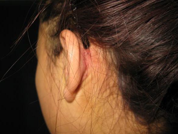 耳后淋巴结肿大 搜狗百科 耳后淋巴结肿大 搜狗百科