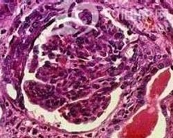 什么叫免疫缺陷性疾病 0