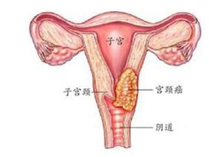 宫颈癌外生型图片图片