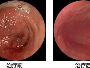 慢性浅表性胃炎