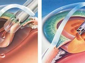 白内障手术