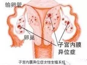 子宫内膜异位症