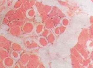 假肥大性肌营养不良