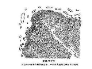 黄体破裂