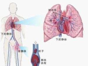 肺栓塞和肺梗死