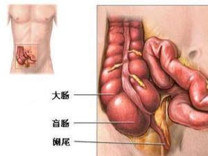 急性阑尾炎