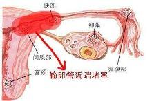 输卵管堵塞