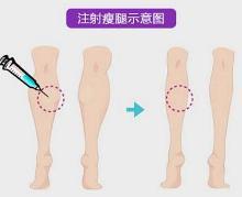 瘦腿针