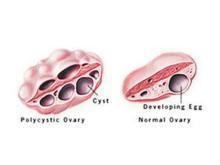 多囊卵巢综合征