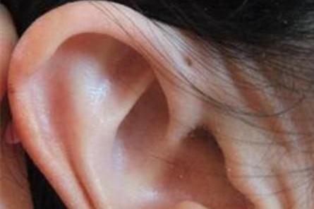 耳前瘘管 搜狗百科 耳前瘘管 搜狗百科