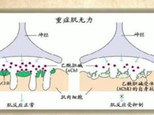 重症肌无力
