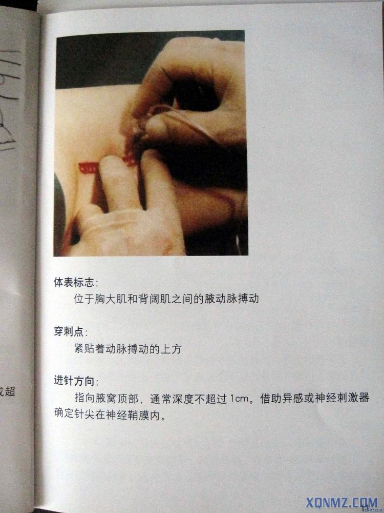 臂丛神经阻滞麻醉