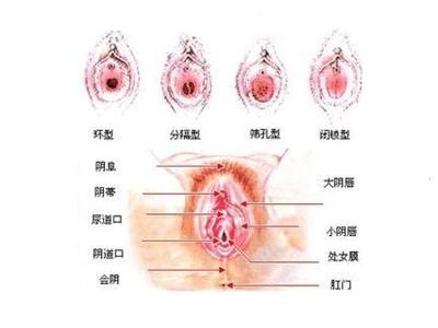 处女膜修补术