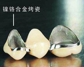 镍铬合金烤瓷牙