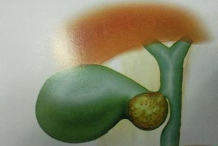 胆囊结石