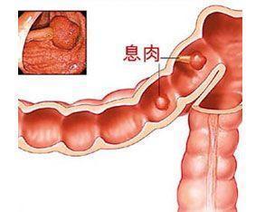 肠息肉的症状表现图片