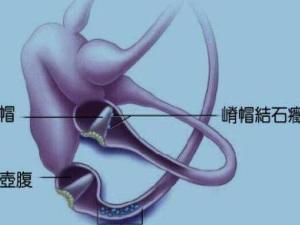 耳石症