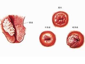 宫颈癌的外观图片图片