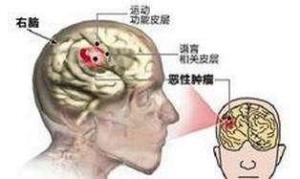 脑瘤