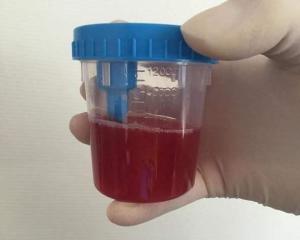 尿颜色变为红色,尿中含有血液称血尿,血尿分为泌尿路性血尿和非泌尿路