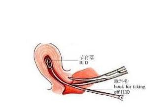 女人上环手术图片