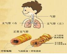 气管炎