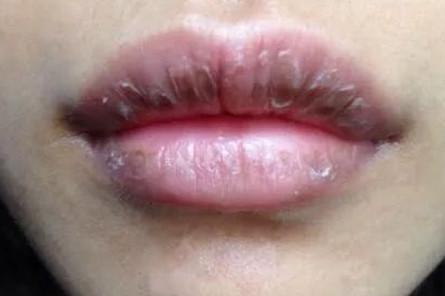 干燥脱屑性唇炎 搜狗百科