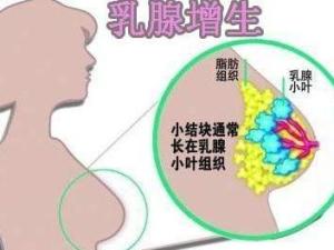 乳腺增生