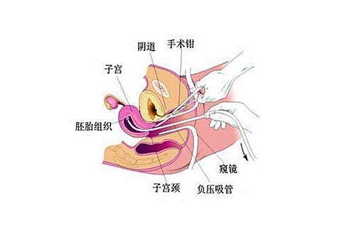 流产 搜狗百科