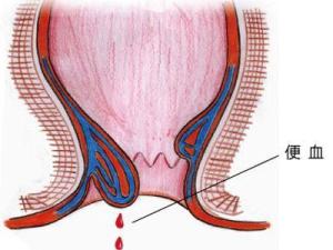 痔疮出血