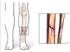 胫腓骨干骨折 搜狗百科