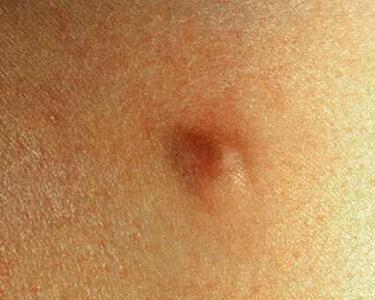 粉刺瘤症状及图片图片