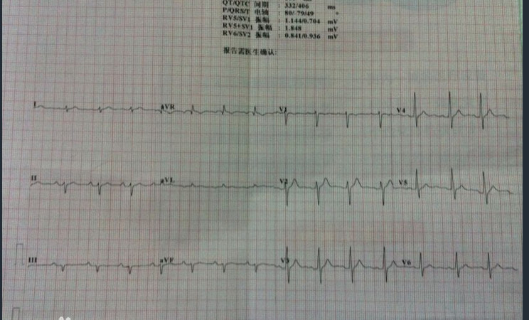 心电轴左偏 搜狗百科