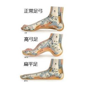 先天性高弓足
