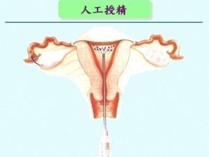 人工受精 搜狗百科 人工受精 搜狗百科