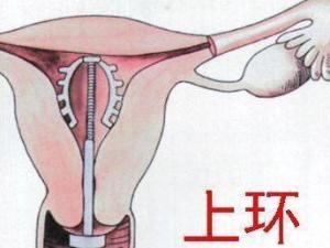 上环