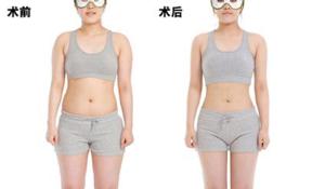 腰部吸脂手术对比效果