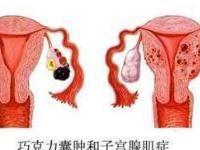 巧克力囊肿