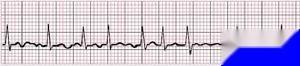 阵发性心房颤动 心电图