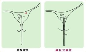 微管可视无痛人流